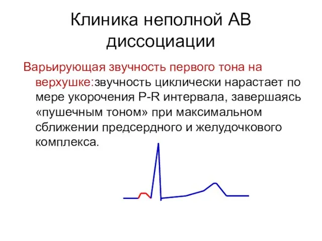 Клиника неполной АВ диссоциации Варьирующая звучность первого тона на верхушке:звучность циклически нарастает