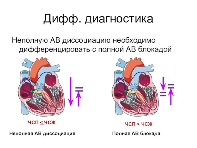 Дифф. диагностика Неполную АВ диссоциацию необходимо дифференцировать с полной АВ блокадой ЧСП