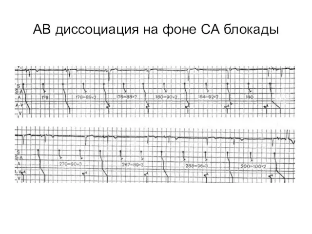 АВ диссоциация на фоне СА блокады