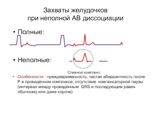 Захваты желудочков при неполной АВ диссоциации Полные: Неполные: Особенности : преждевременность, частая