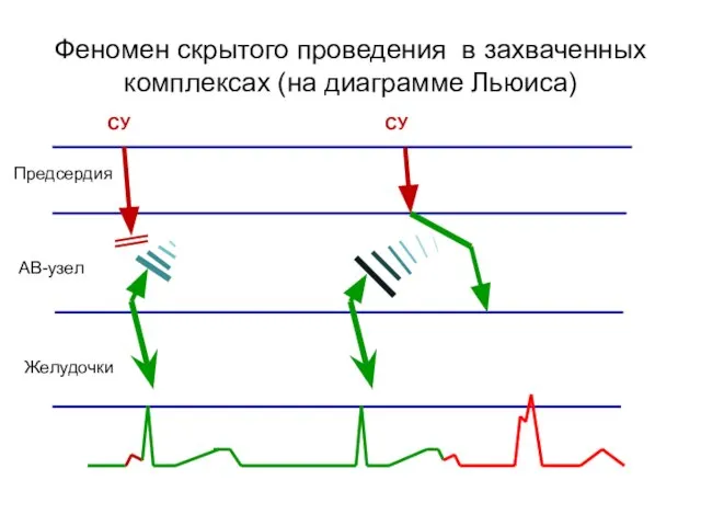 Феномен скрытого проведения в захваченных комплексах (на диаграмме Льюиса) Предсердия АВ-узел Желудочки СУ СУ