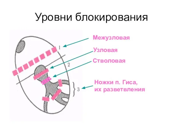 Уровни блокирования Межузловая Узловая Стволовая Ножки п. Гиса, их разветвления