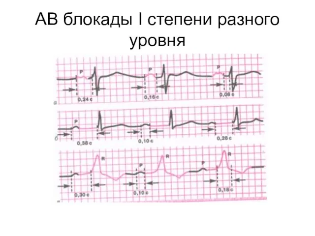 АВ блокады I степени разного уровня