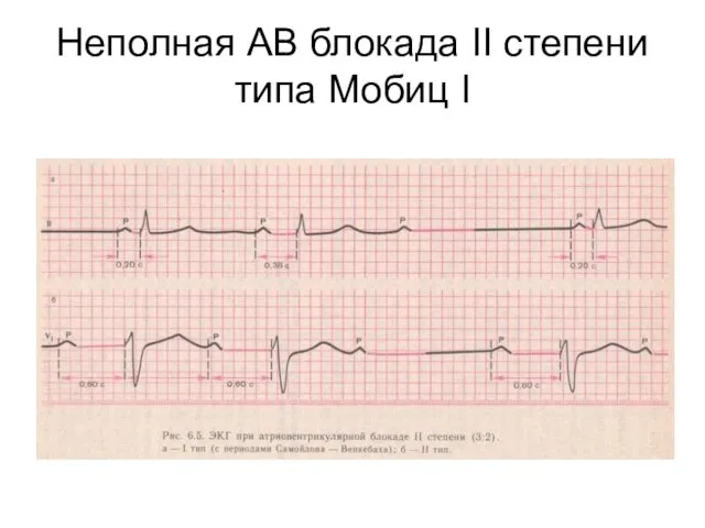 Неполная АВ блокада II степени типа Мобиц I