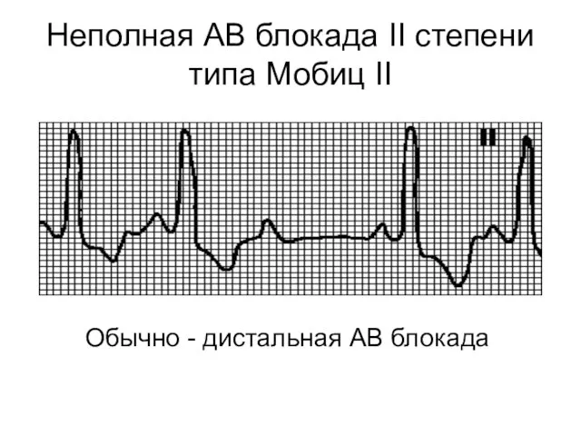 Неполная АВ блокада II степени типа Мобиц II Обычно - дистальная АВ блокада
