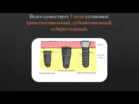 Всего существует 3 вида установки: трансгингивальный, субгингивальный, субкрестальный.