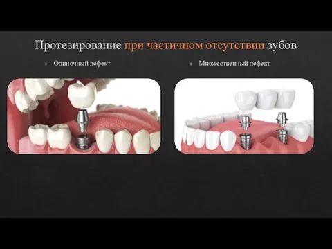 Протезирование при частичном отсутствии зубов Одиночный дефект Множественный дефект