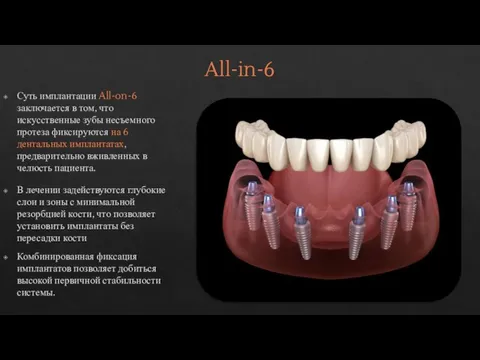 All-in-6 Суть имплантации All-on-6 заключается в том, что искусственные зубы несъемного протеза