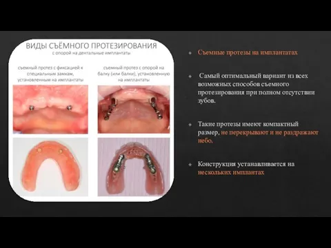 Съемные протезы на имплантатах Самый оптимальный вариант из всех возможных способов съемного