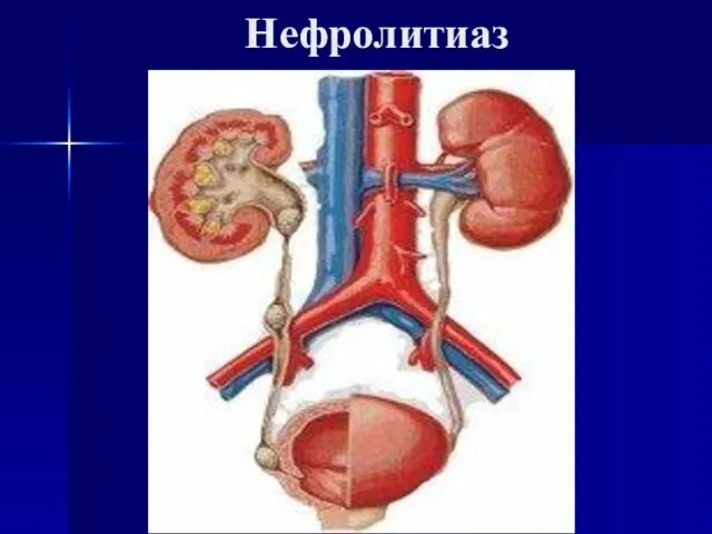 Нефролитиаз