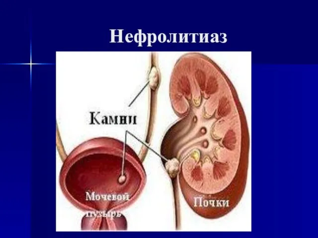 Нефролитиаз