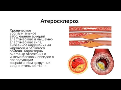 Атеросклероз Хроническое воспалительное заболевание артерий эластического и мышечно-эластического типа, вызванное нарушениями жирового