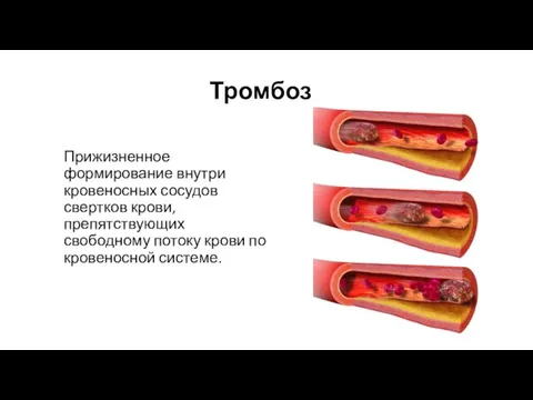 Прижизненное формирование внутри кровеносных сосудов свертков крови, препятствующих свободному потоку крови по кровеносной системе. Тромбоз