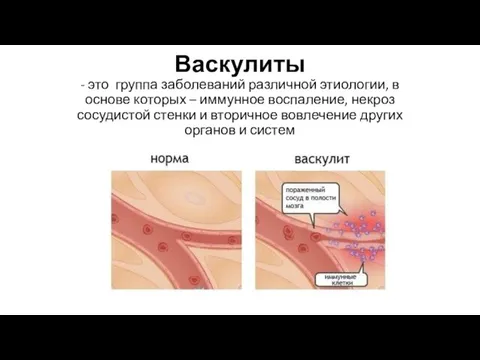 Васкулиты - это группа заболеваний различной этиологии, в основе которых – иммунное