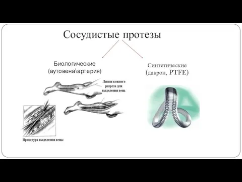 Биологические (аутовена\артерия) Синтетические (дакрон, PTFE) Сосудистые протезы