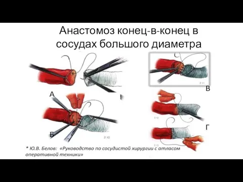 Анастомоз конец-в-конец в сосудах большого диаметра