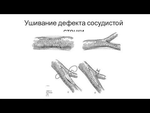 Ушивание дефекта сосудистой стенки