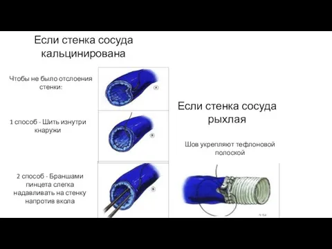 Если стенка сосуда кальцинирована Если стенка сосуда рыхлая Чтобы не было отслоения