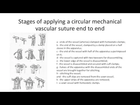 Stages of applying a circular mechanical vascular suture end to end a