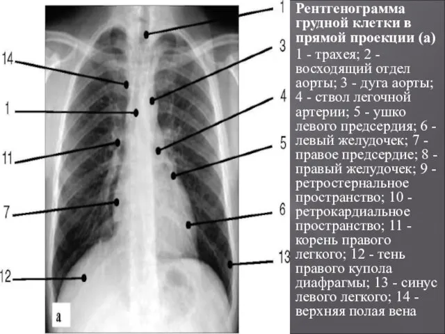 Рентгенограмма грудной клетки в прямой проекции (а) 1 - трахея; 2 -