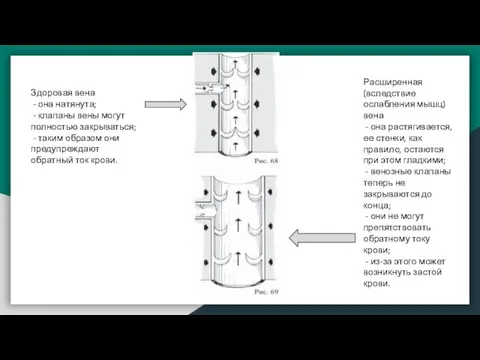 Здоровая вена - она натянута; - клапаны вены могут полностью закрываться; -