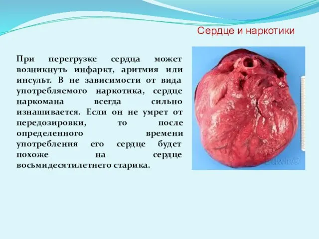 Сердце и наркотики При перегрузке сердца может возникнуть инфаркт, аритмия или инсульт.