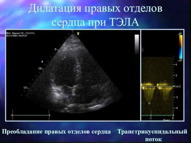 Дилатация правых отделов сердца при ТЭЛА Преобладание правых отделов сердца Транстрикуспидальный поток