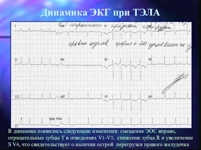 Динамика ЭКГ при ТЭЛА В динамике появились следующие изменения: смещение ЭОС вправо,