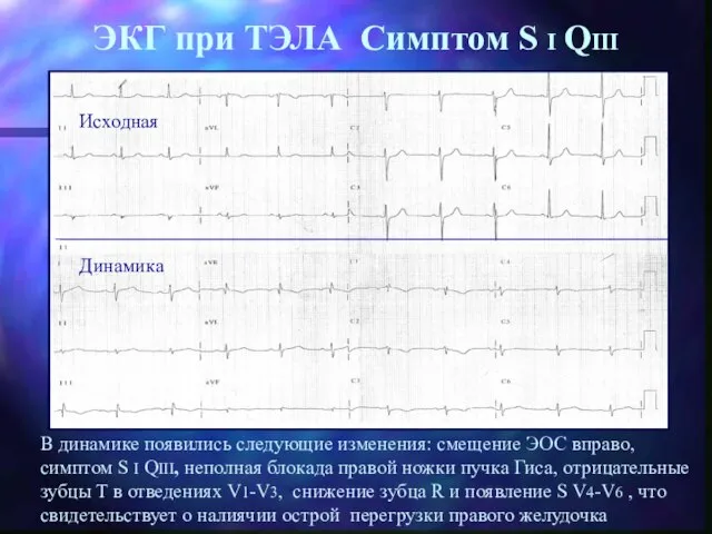 ЭКГ при ТЭЛА Симптом S I QIII Исходная Динамика В динамике появились