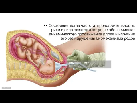 • Состояние, когда частота, продолжительность, ритм и сила схваток и потуг, не