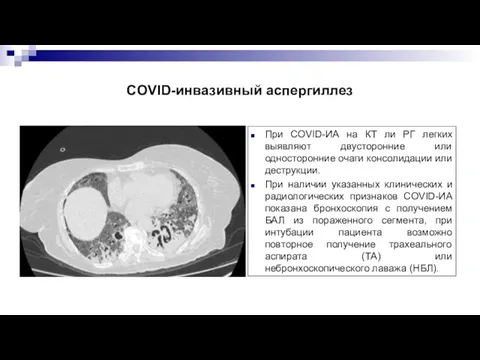 COVID-инвазивный аспергиллез При COVID-ИА на КТ ли РГ легких выявляют двусторонние или