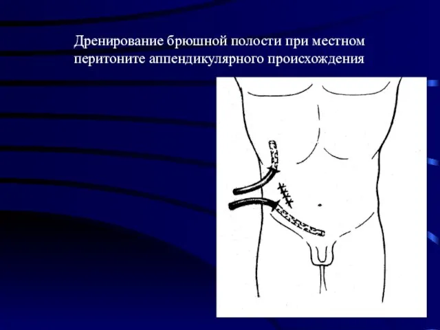 Дренирование брюшной полости при местном перитоните аппендикулярного происхождения