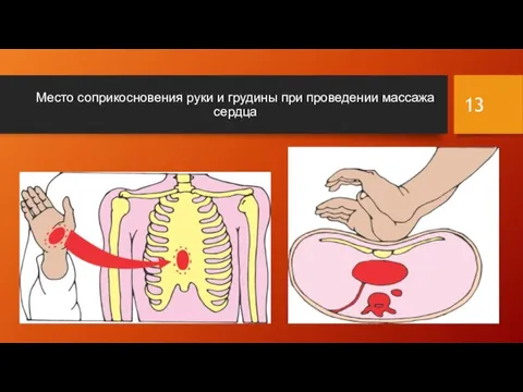 Место соприкосновения руки и грудины при проведении массажа сердца