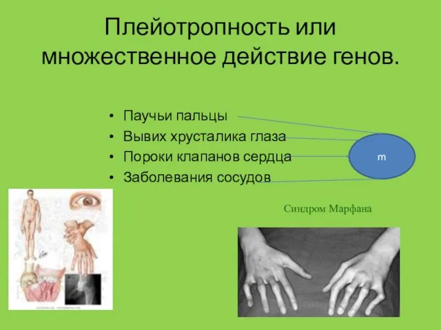 Плейотропность или множественное действие генов. Паучьи пальцы Вывих хрусталика глаза Пороки клапанов