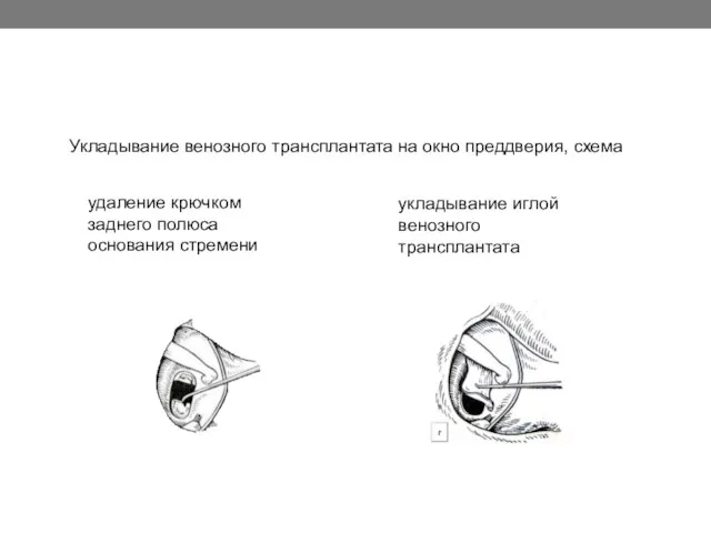 Укладывание венозного трансплантата на окно преддверия, схема удаление крючком заднего полюса основания