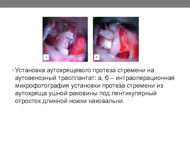 Установка аутохрящевого протеза стремени на аутовенозный трасплантат: а, б – интраоперационная микрофотография