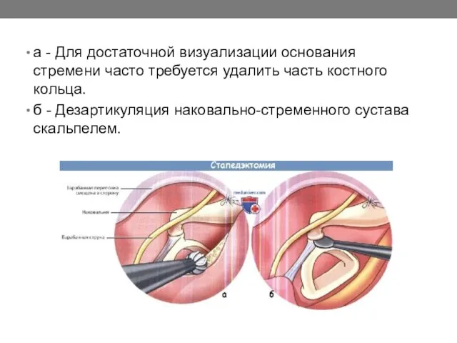 а - Для достаточной визуализации основания стремени часто требуется удалить часть костного