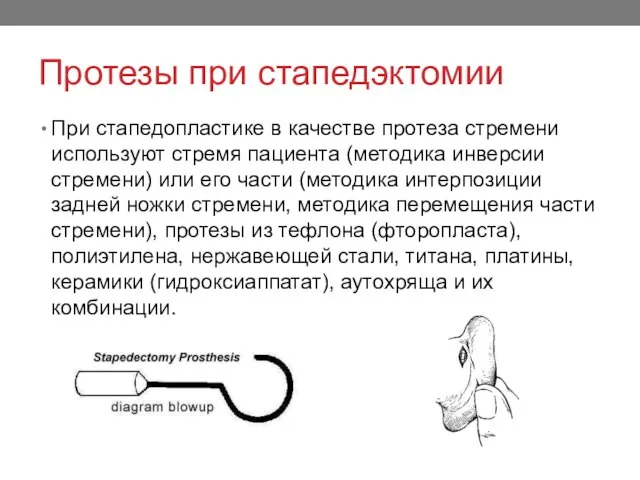 Протезы при стапедэктомии При стапедопластике в качестве протеза стремени используют стремя пациента