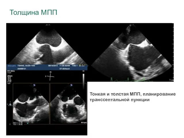 Толщина МПП Тонкая и толстая МПП, планирование транссептальной пункции