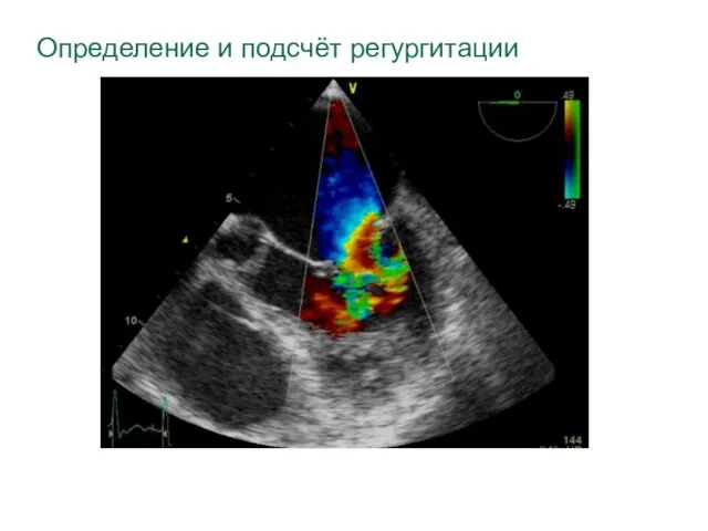 Определение и подсчёт регургитации