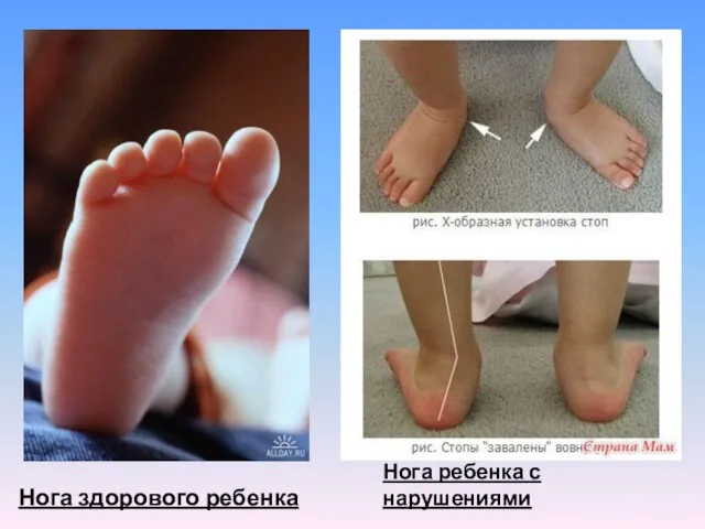 Нога здорового ребенка Нога ребенка с нарушениями