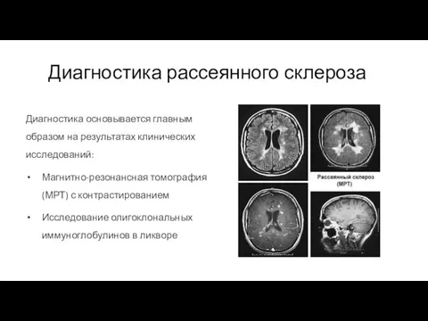 Диагностика рассеянного склероза Диагностика основывается главным образом на результатах клинических исследований: Магнитно-резонансная