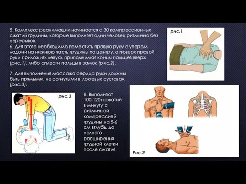 5. Комплекс реанимации начинается с 30 компрессионных сжатий грудины, которые выполняет один