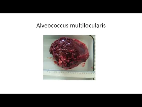 Alveococcus multilocularis