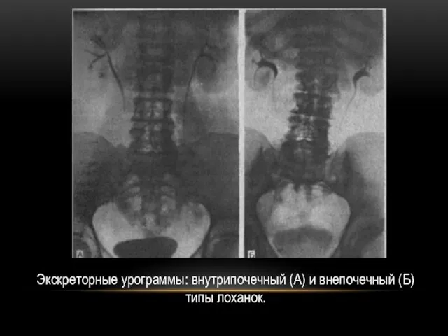 Экскреторные урограммы: внутрипочечный (А) и внепочечный (Б) типы лоханок.