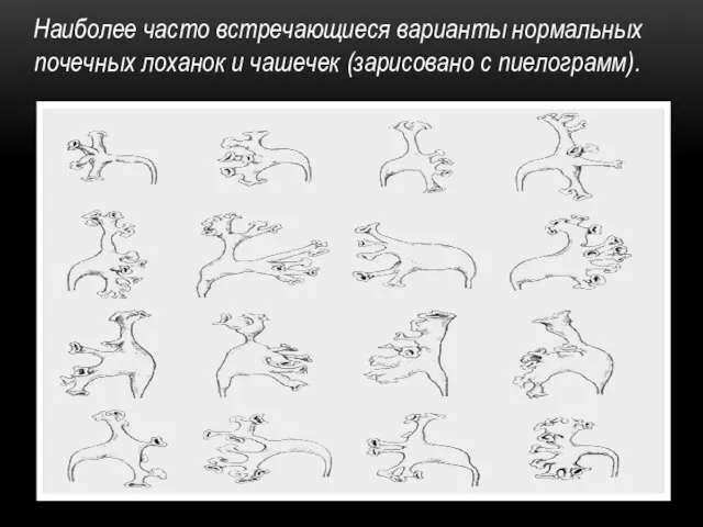 Наиболее часто встречающиеся варианты нормальных почечных лоханок и чашечек (зарисовано с пиелограмм).