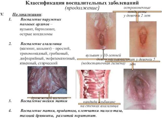 По локализации: Воспаление наружных половых органов – вульвит, бартолинит, острые кондиломы Воспаление