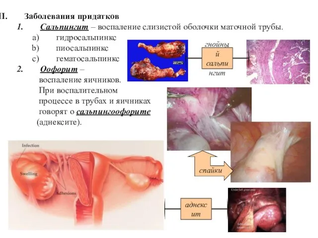 Заболевания придатков Сальпингит – воспаление слизистой оболочки маточной трубы. гидросальпинкс пиосальпинкс гематосальпинкс