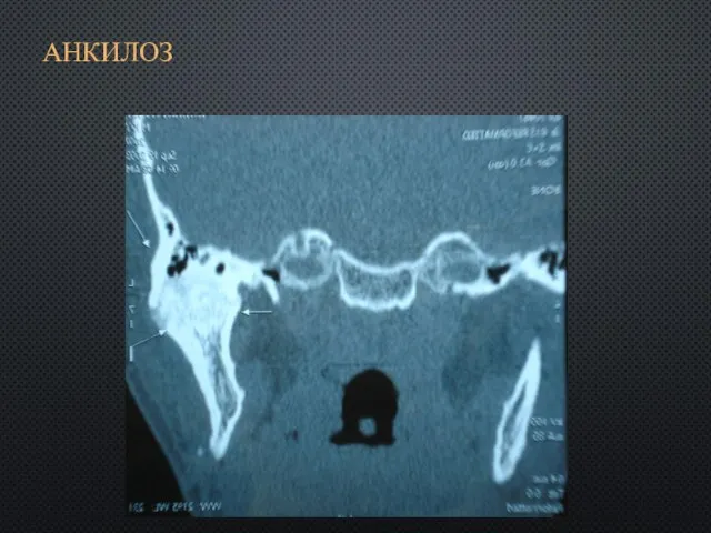 АНКИЛОЗ
