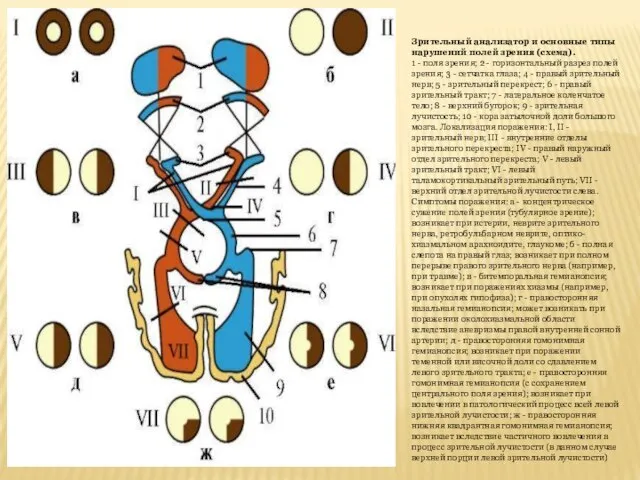 Зрительный анализатор и основные типы нарушений полей зрения (схема). 1 - поля